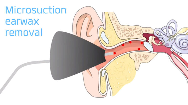 Ear wax removal by Microsuction